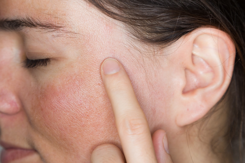 macchie-post-acne-guance