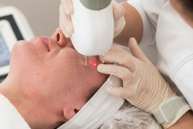 macchie-sul-viso-laser