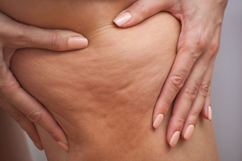 ozonoterapia-cellulite