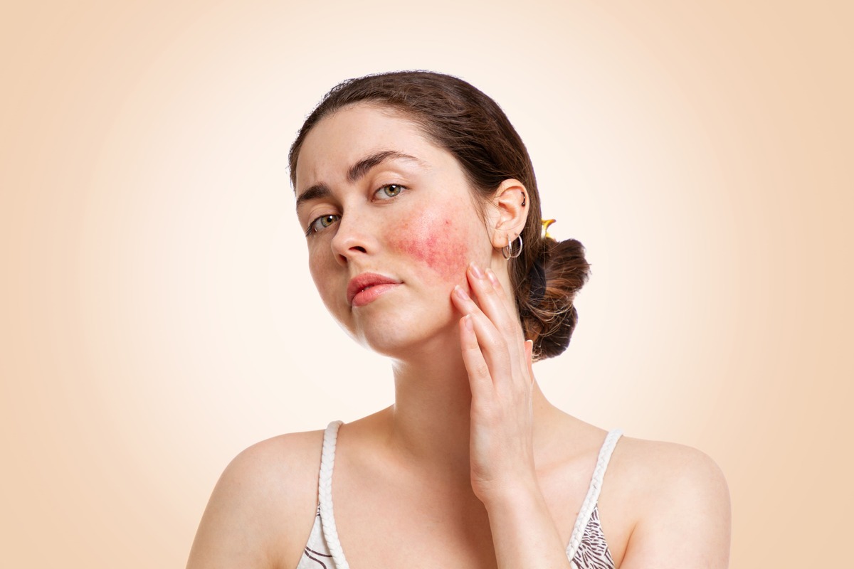 rosacea-foto