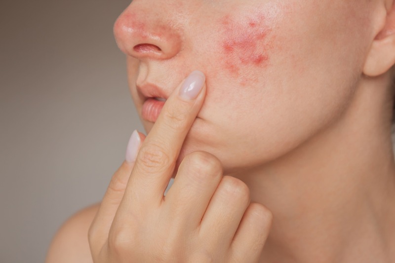 rosacea-sintomi-papule