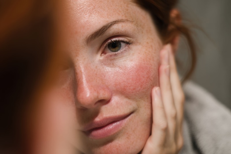 rosacea-sintomi-rossore