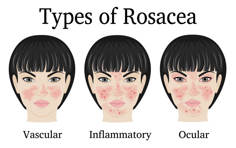 rosacea-tipologie